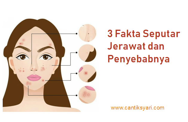 3 Fakta Seputar Jerawat dan Penyebabnya - Cantik Syari